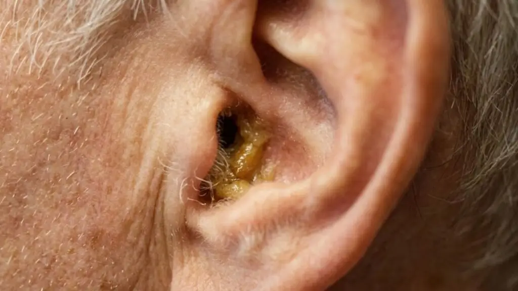 Why Does Earwax Build Up?
