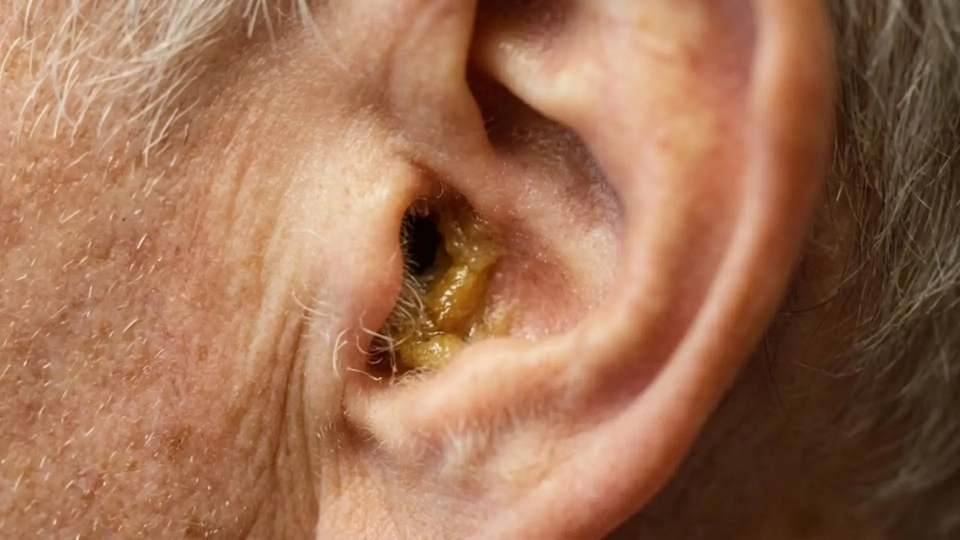 Why Does Earwax Build Up?